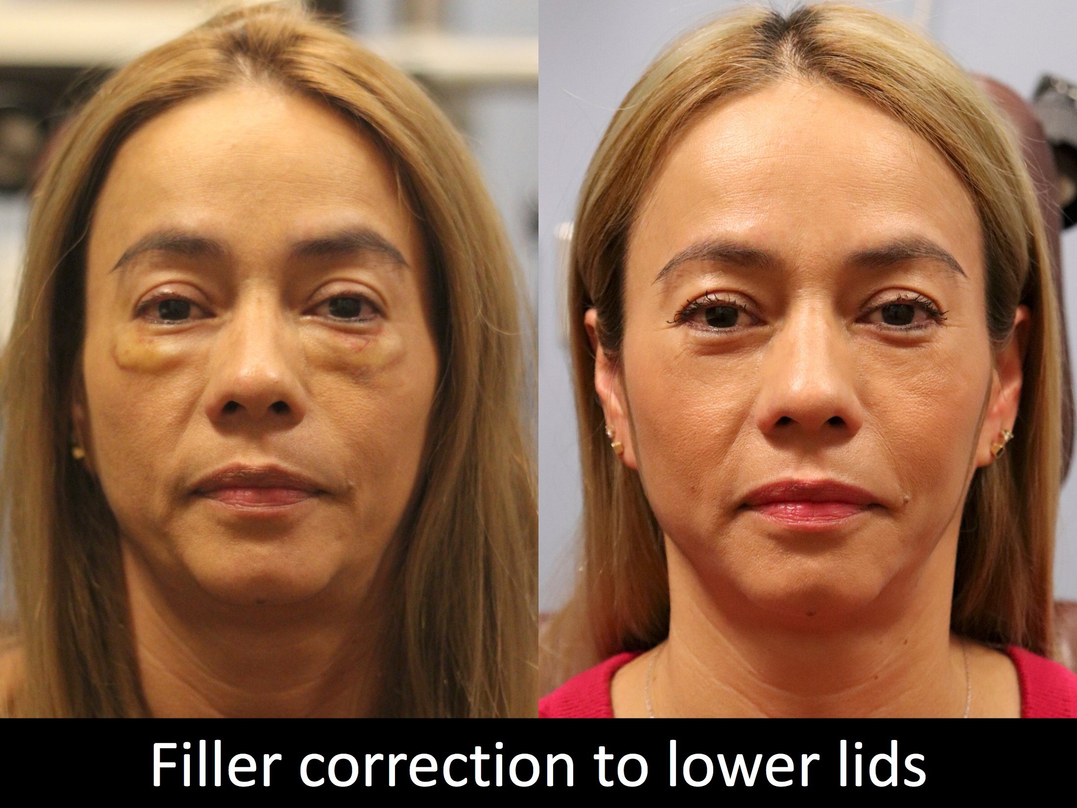 denver-facial-aesthetics-blog-botox-dermal-fillers